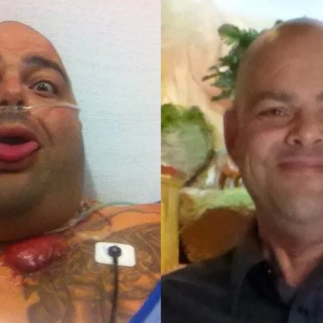 Episode 94: Thyroid Cancer, Lung Cancer, 39 Surgeries and Massive Weight Gain