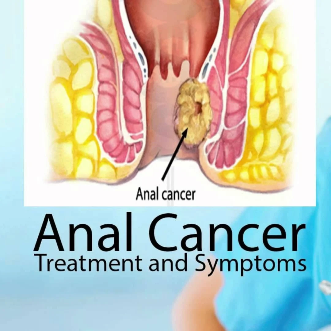 Episode 81: Cannabis Cleared His Anal Cancer