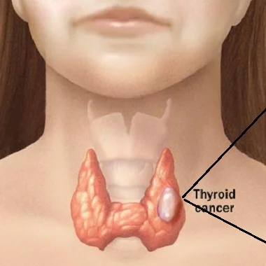 Episode 57: She Refused Surgery and Instead Used Cannabis Oil for Thyroid Cancer