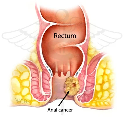 Episode 46: She Cleared Her Anal Canal Cancer Using Cannabis And Other Natural Supplements