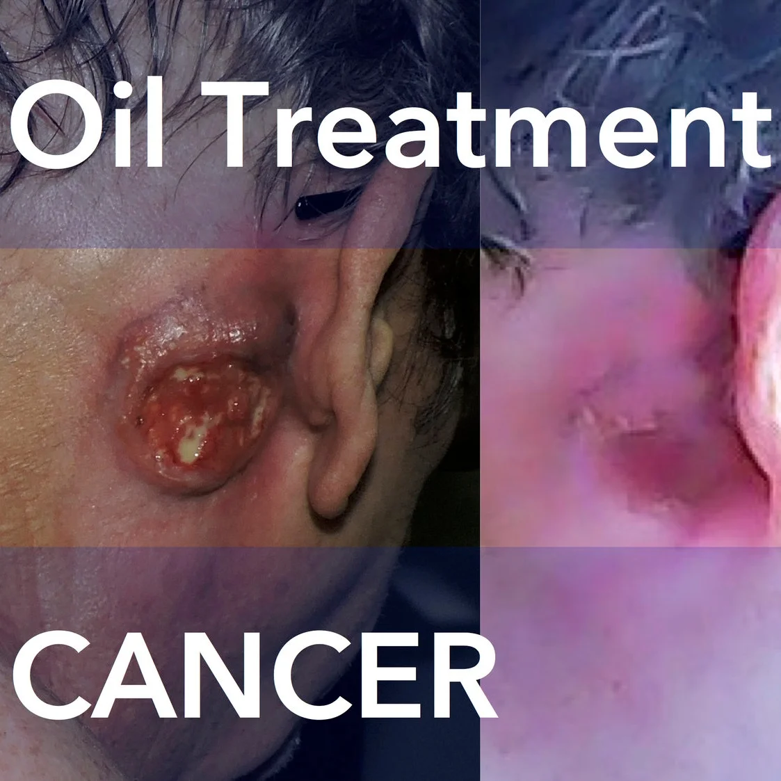 Episode 178: A Massive Infected Cancerous Tumor Behind His Ear Cleared With Cannabis Oil