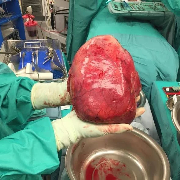 Episode 173: She Was Symptom Free But An X-Ray Revealed A Giant Tumor In Her Abdomen