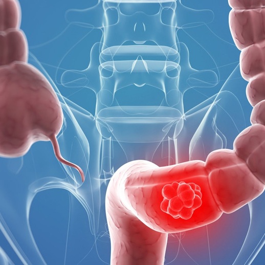 Episode 169: Chemo and Radiation Weren't Working For His Colon Cancer, But Cannabis Is