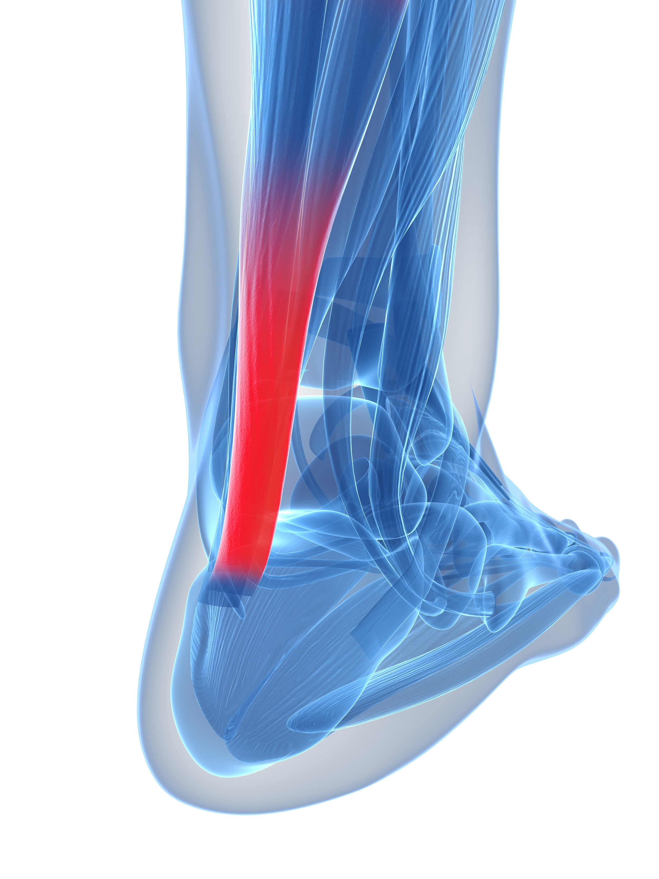 What Is Achilles Tendonitis and How Is It Treated? | The Podiatry Group of  South Texas