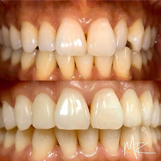 Smile with confidence with teeth you love. Here  are some &ldquo;No Preparation&rdquo; Veneers. This is  where no tooth structure is removed and a porcelain &ldquo;laminate veneer&rdquo; is placed on the lateral incisors to provide shape, color and e