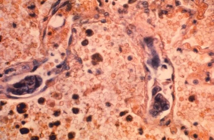 Combatting Cancer Health Disparities 