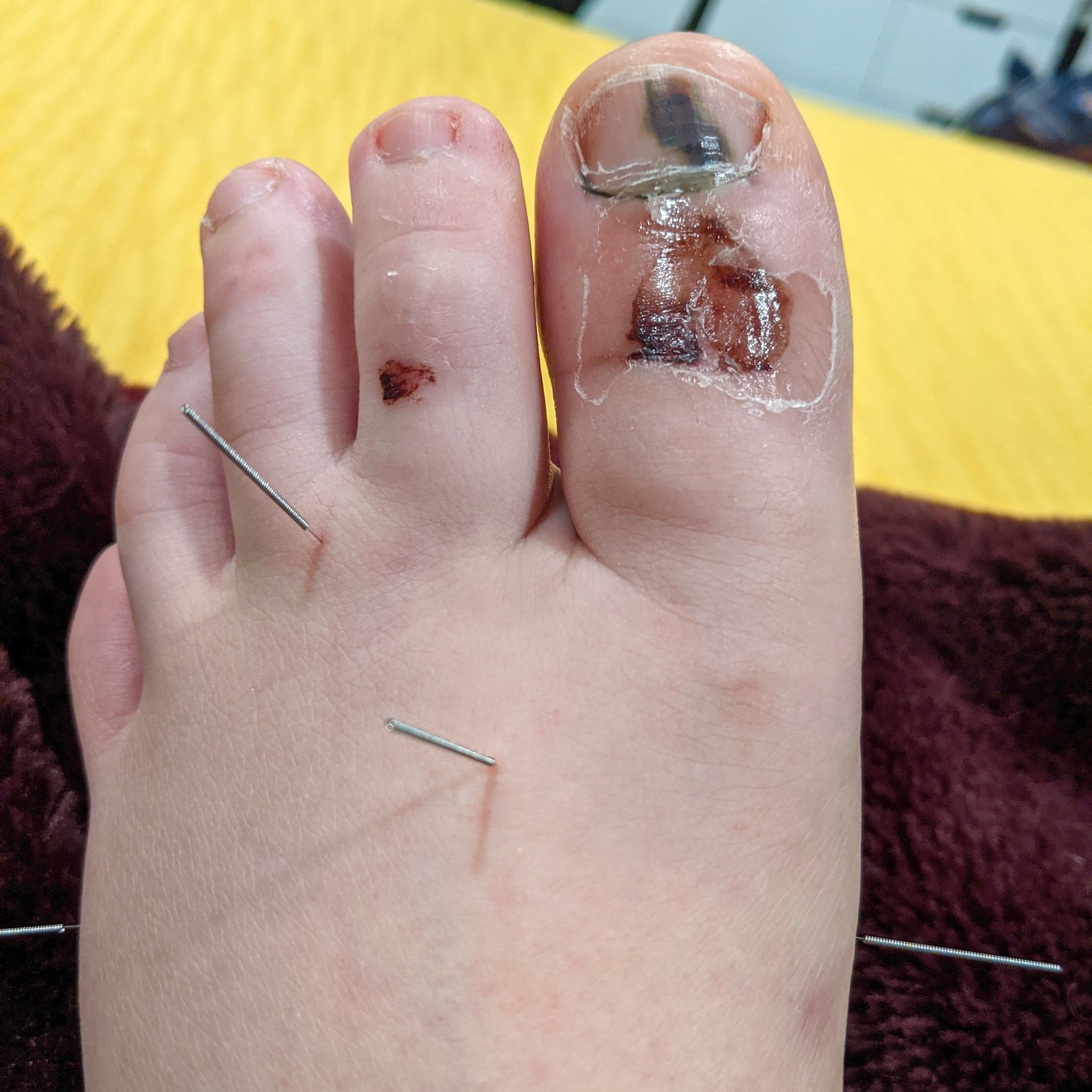 Traditional Chinese Medicine Case Report: Broken Big Toe — Alina Rehkopf