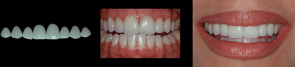lea-veneers.jpg