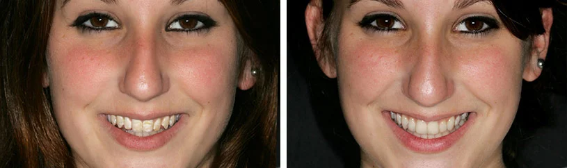 porcelain-veneers2.jpg