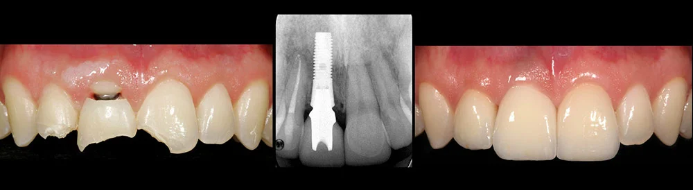 randy-implant1.jpg