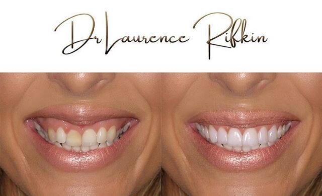 Artistic Vision and comprehensive planning with veneers, upper lip Botox and dermal filler with minor precision gingival surgery can create the most beautiful smile. Treatment best performed with Dental operating microscope.
Look at the entire face. 