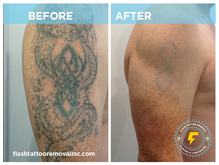 How Does Laser Tattoo Removal Work In Calgary — FLASH Tattoo Removal Inc