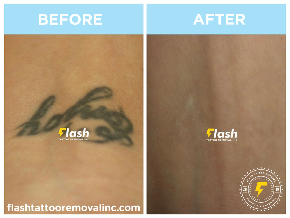 FLASH Tattoo Removal Inc | Laser Tattoo Removal & Fading Calgary