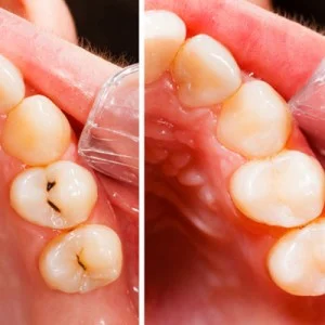 fillings-square-300x300.jpg