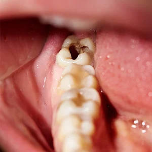 cavities-square.jpg