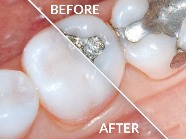 BeforeAfter_mercury-free tooth.jpg