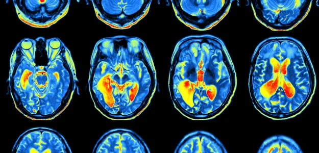 brain-scan-ADHD.jpg