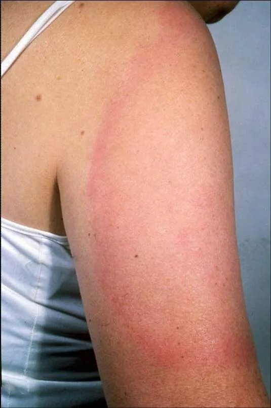 Lyme 1.jpg