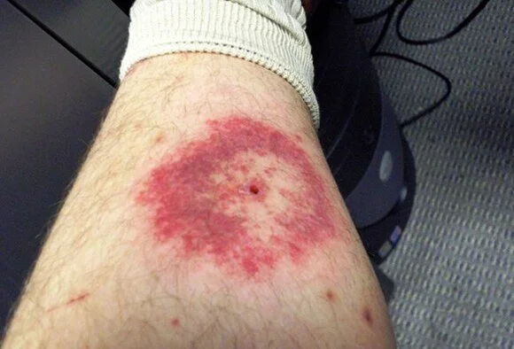 Lyme 5.jpg