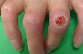 Scleroderma 2.jpg