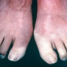 Scleroderma 10.jpg
