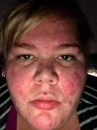 Scleroderma 9.jpg