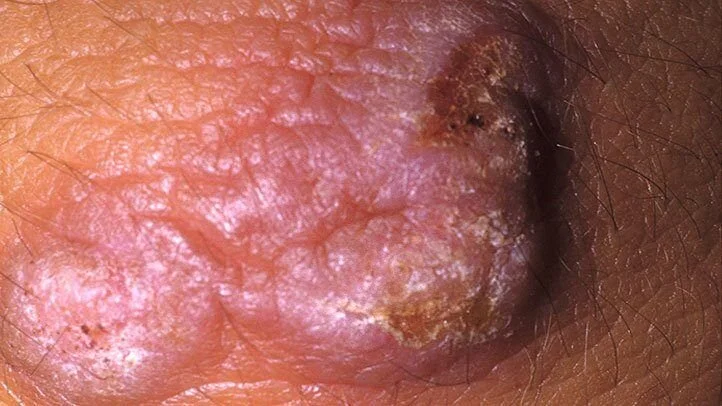 Syphilis02.jpg