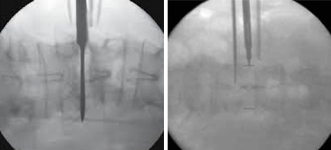 With the patient placed on their side, a series of dilating tubes are sequentially inserted and docked beside the disc space of interest. Intraoperative xrays of the lateral access, discectomy, and placement of a large intervertebral fusion cage.