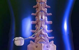 Spinal Cord Stimulation  Cincinnati, OH Mayfield Brain & Spine