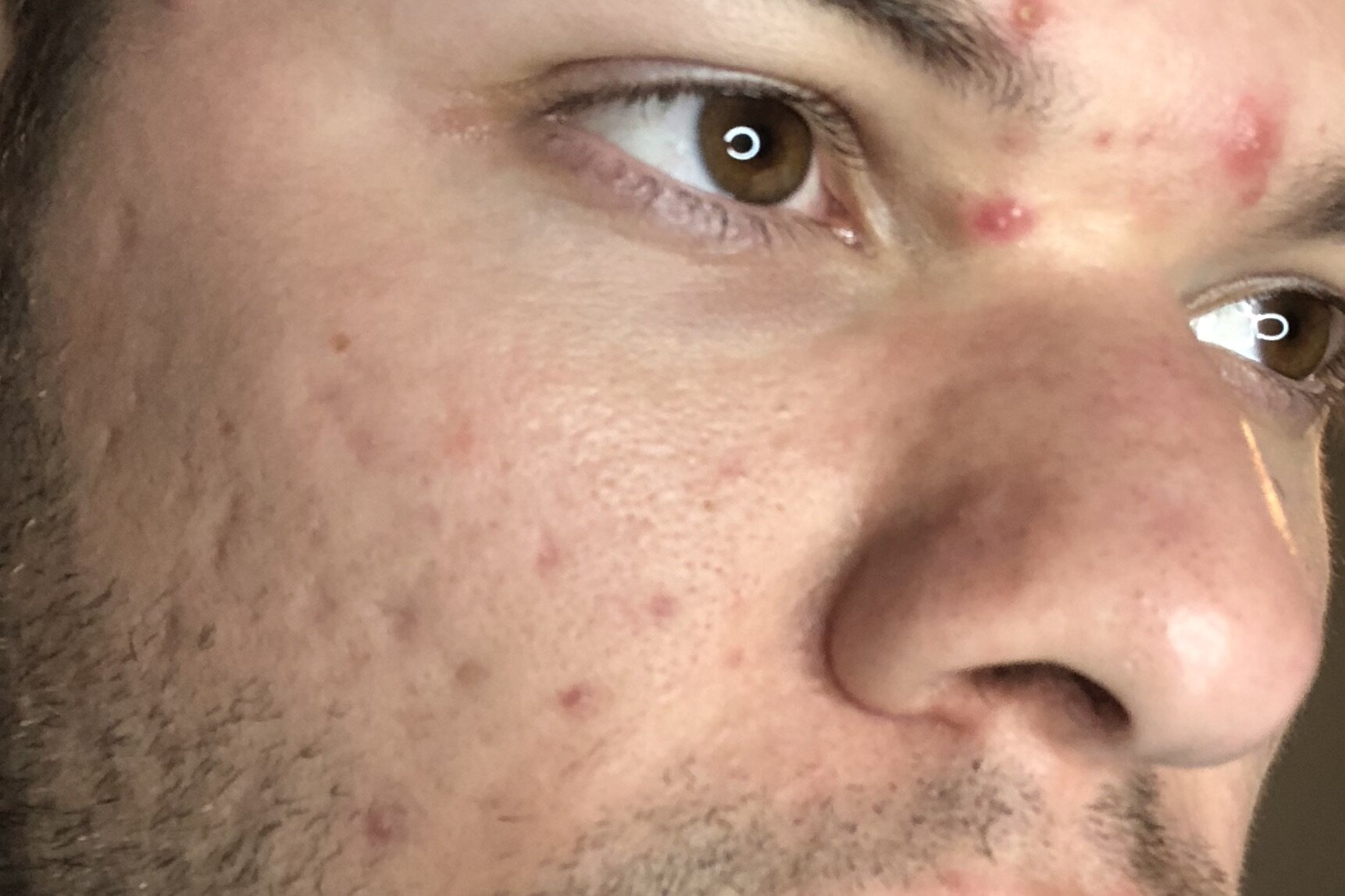 banish acne scars review