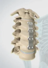anterior-cervical-corpectomy.jpg