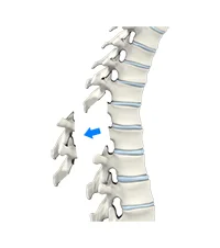 laminectomy.jpg