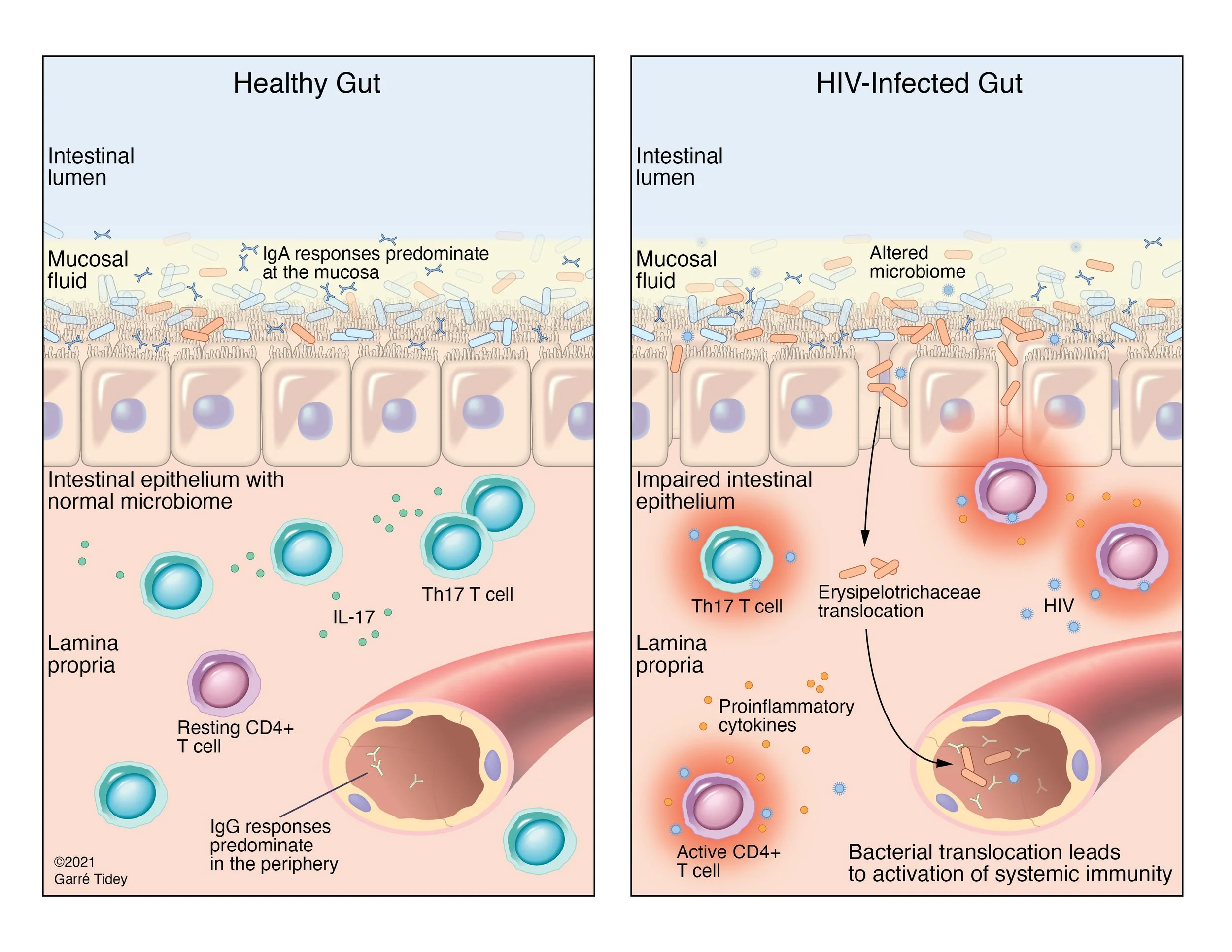 Bacterial Translocation at the HIV+ Gut Epithelial Surface. Media: Adobe Illustrator