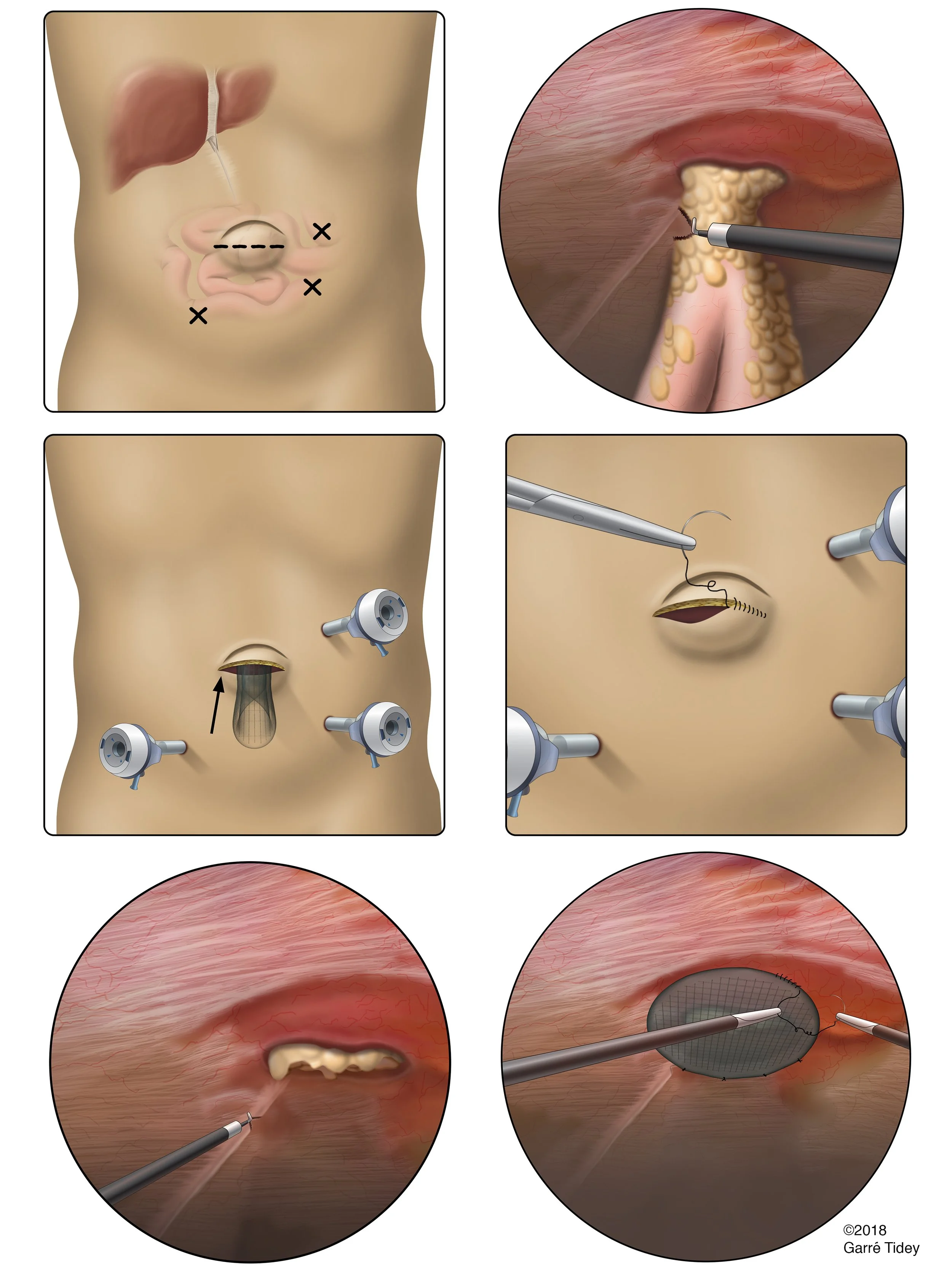 Umbilical Hernia Repair with Mesh. Media: Adobe Photoshop, Adobe Illustrator, Autodesk Maya