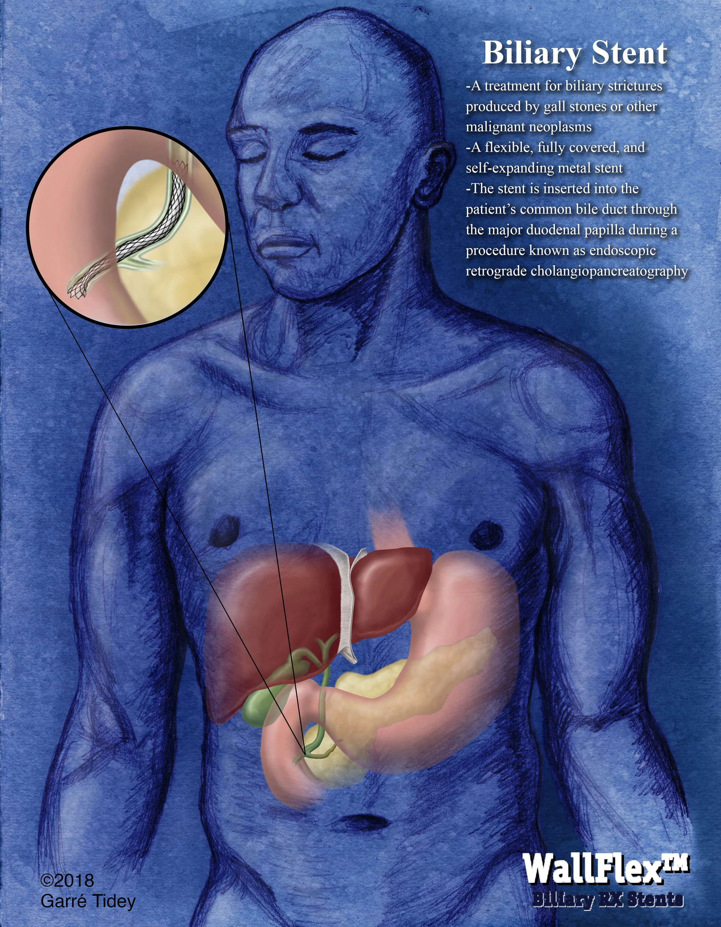 Biliary Stent Implantation. Media: Graphite, Watercolor, Adobe Photoshop, Adobe Illustrator, Adobe InDesign