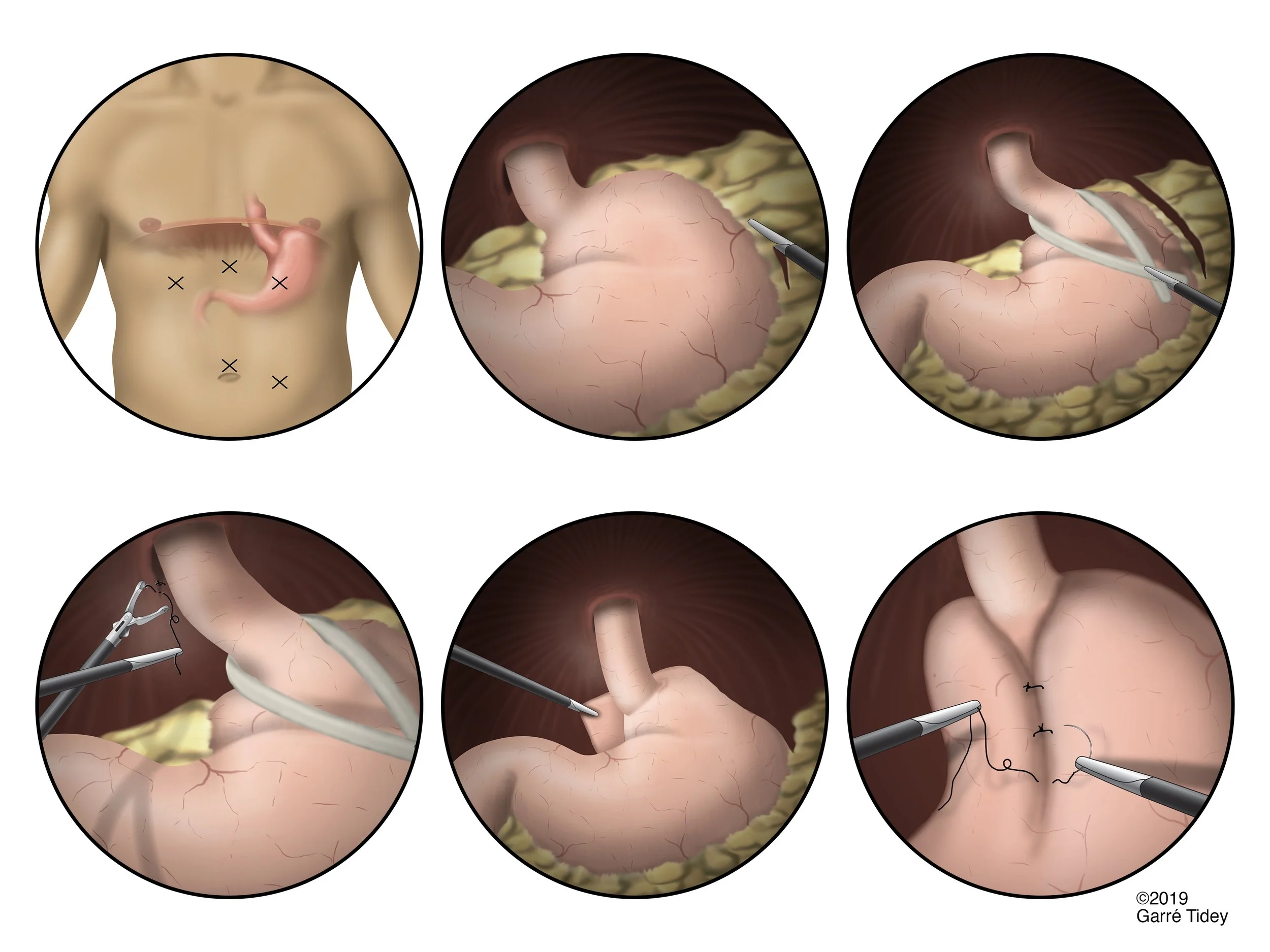 Nissen Fundoplication with Hiatal Hernia Repair. Media: Adobe Photoshop, Adobe Illustrator, Adobe InDesign