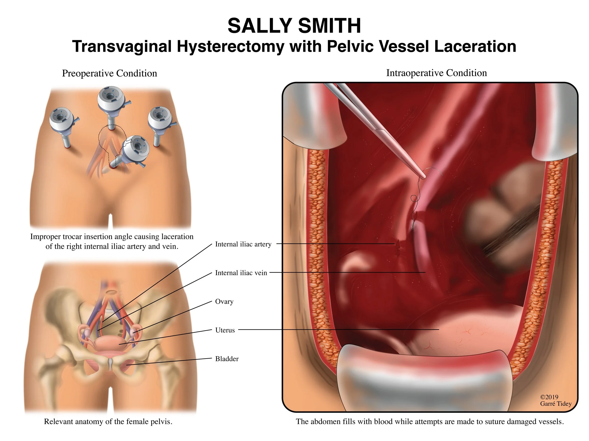 Medical Legal Illustration of Transvaginal Hysterectomy with Pelvic Vessel Laceration. Media: Adobe Photoshop, Adobe Illustrator