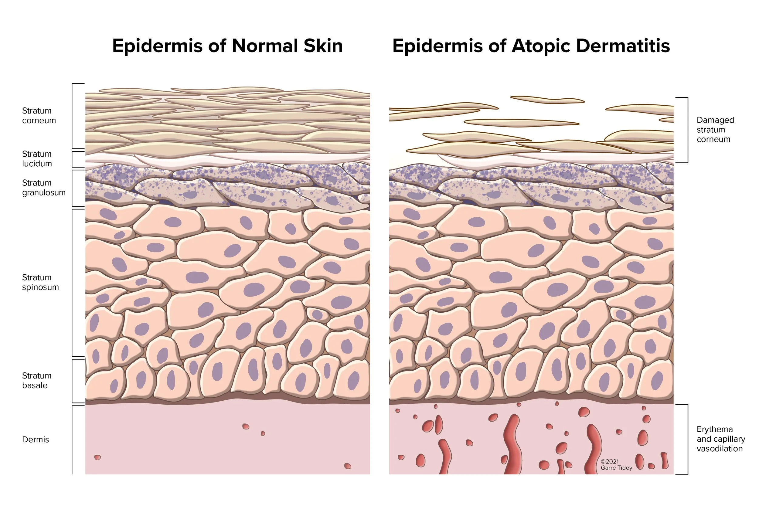 Epidermis of Normal Skin vs. Atopic Dermatitis. Media: Adobe Illustrator, Adobe Indesign