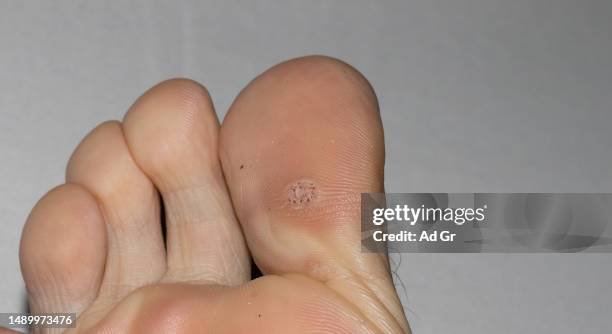 Verruca (Plantar Wart) Treatment: Causes, Symptoms &amp; When to See a Podiatrist