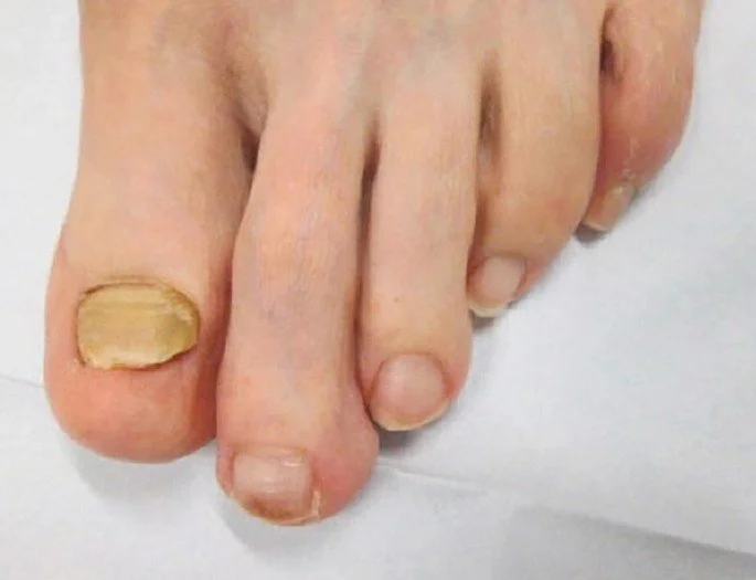 Thickened Nail Care: Causes, Treatment &amp; When to See a Podiatrist