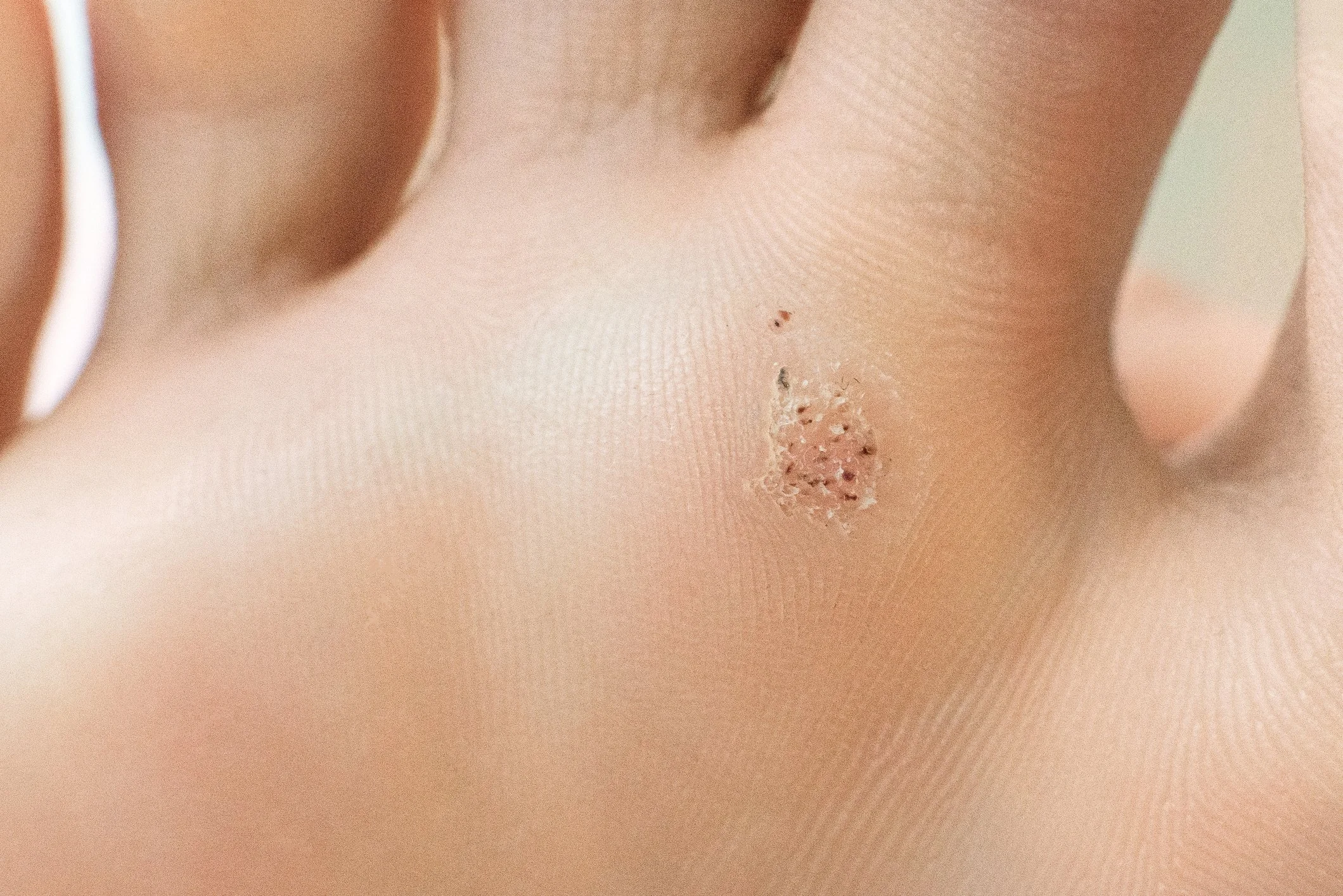 Verruca (Plantar Wart) Treatment: Causes, Symptoms &amp; When to See a Podiatrist