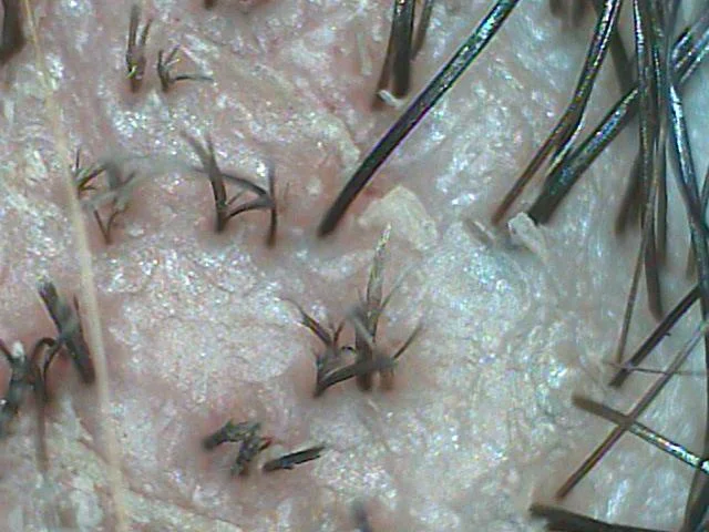 Tinea Capitis May 2011close-up.jpg