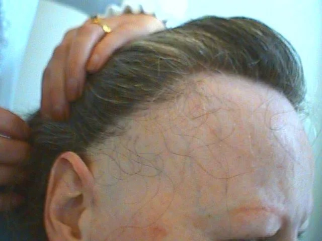 Frontal Fibrosing Alopecia.jpg