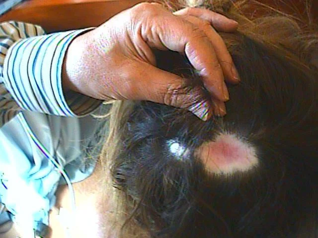 Chemical burn from foils.jpg