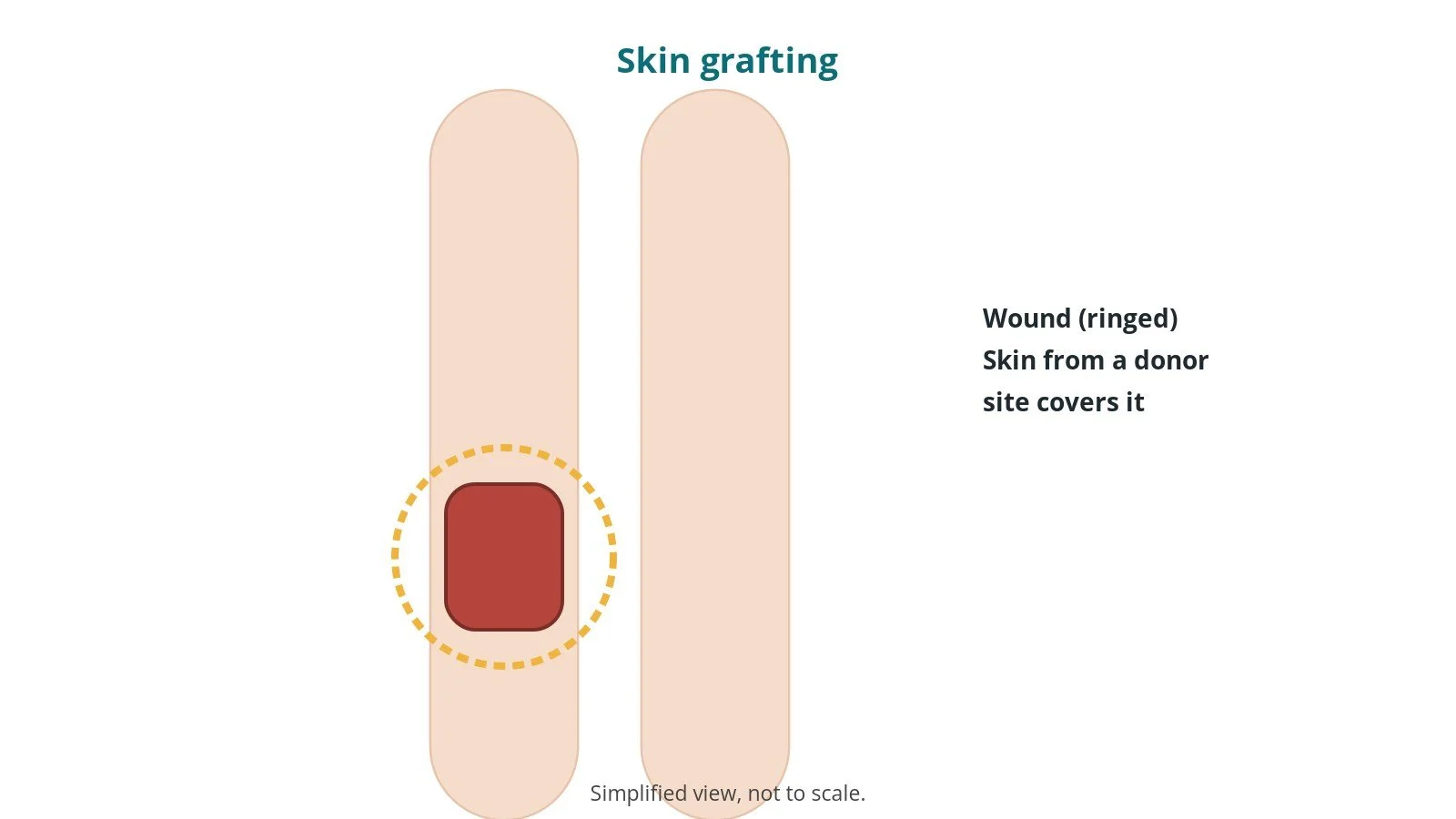 Diagram of two legs with a wound on one leg ringed