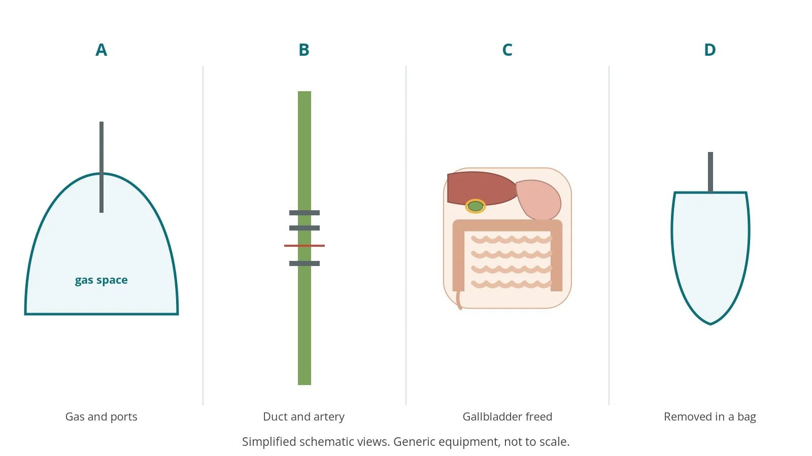 Four-panel schematic of lap chole: gas and ports, duct and artery, gallbladder freed, removed in a bag