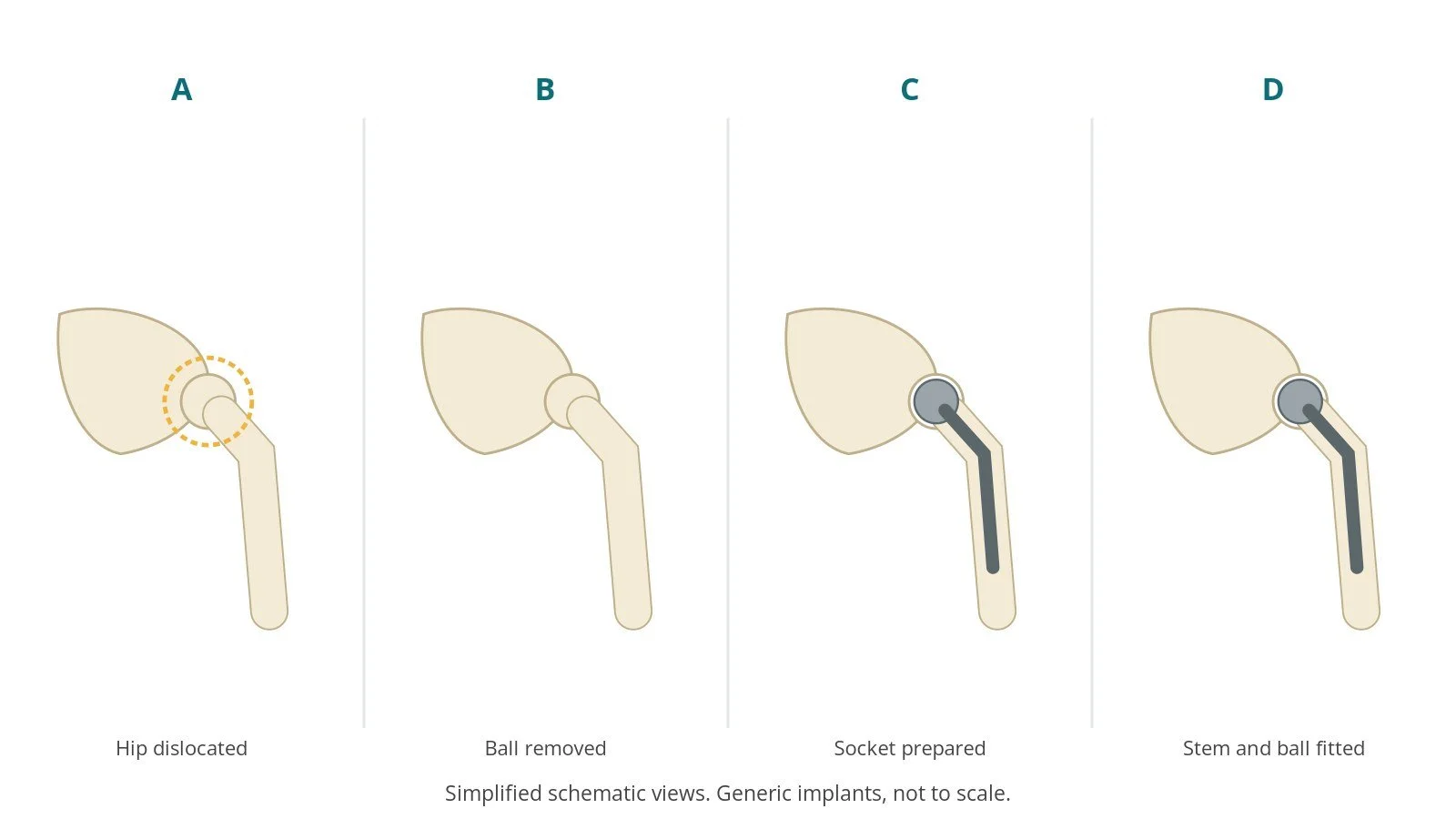 Four-panel schematic of hip replacement: hip dislocated, ball removed, socket prepared, stem and ball fitted