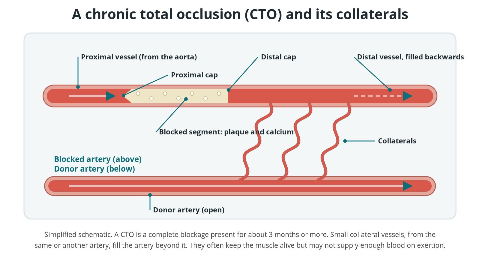 Schematic of a blocked coronary artery showing the proximal cap, the blocked segment with calcium, the distal cap, and small collateral vessels from an open donor artery filling the artery beyond the blockage