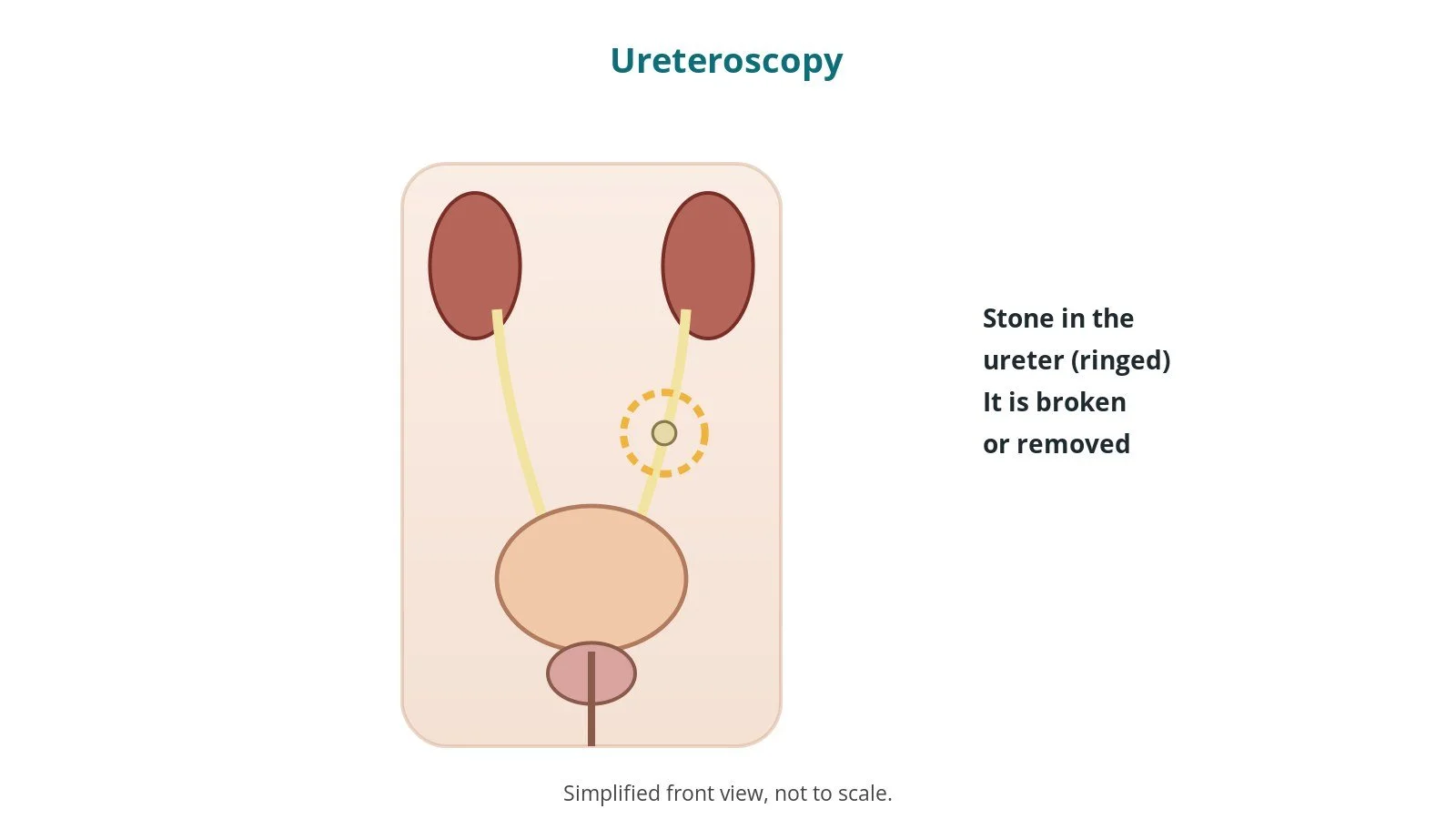 Diagram of the urinary tract with a stone in one ureter ringed
