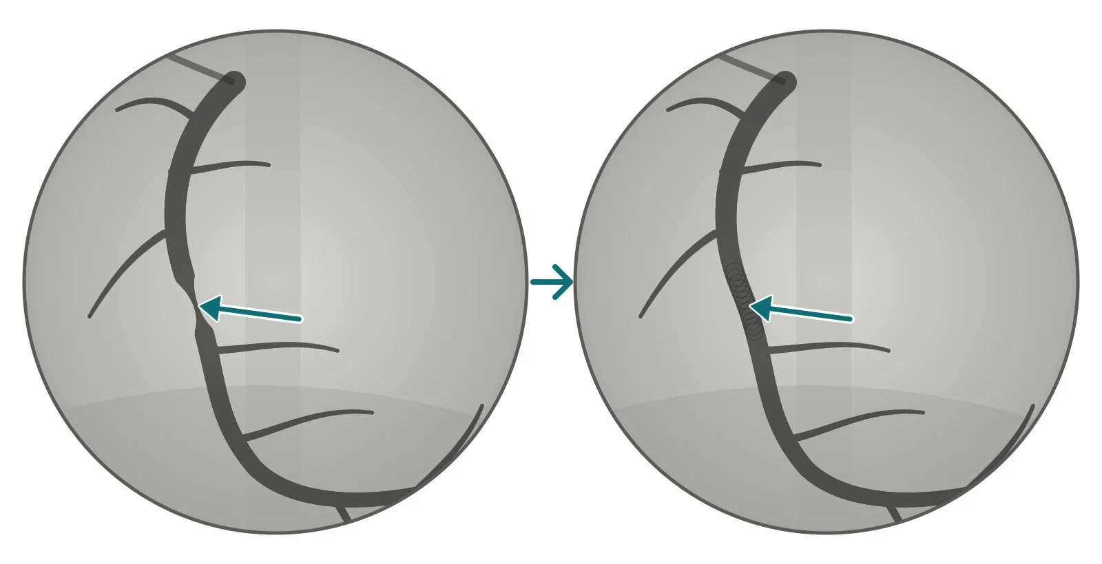 Diagram 5: illustration of the angiogram before and after PCI